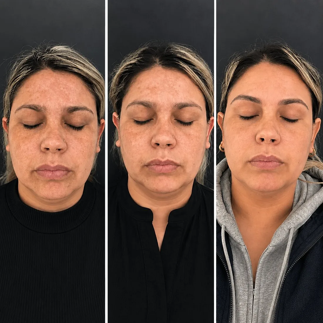 Rosto de frente em três etapas: sardas e manchas ficando mais uniformes ao longo do tempo.
